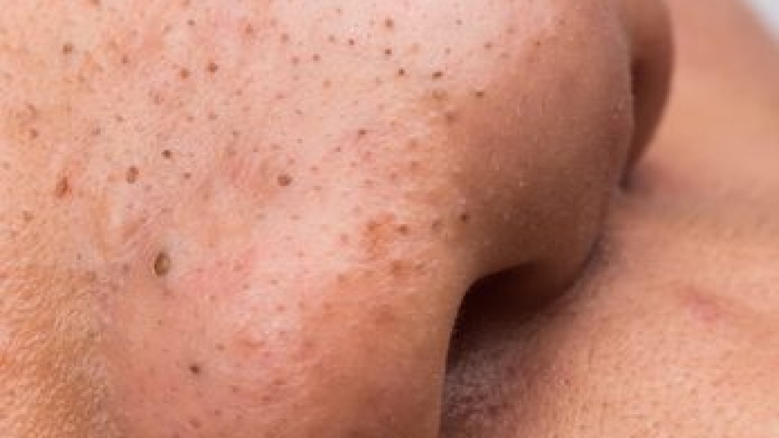 8 công thức tại nhà giúp loại bỏ mụn đầu đen cực kỳ hiệu quả